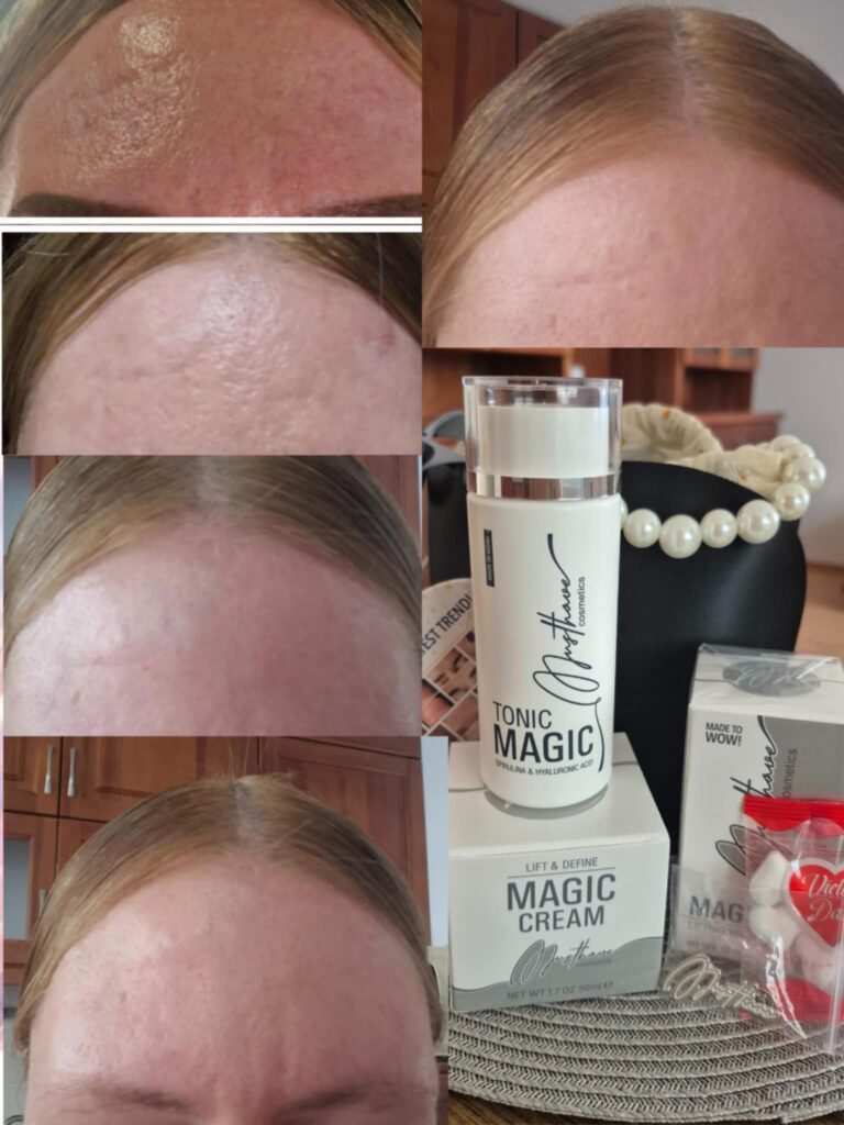 Saját fotóim, előtte és utána állapot. Varázslatos változás a bőrömön, a Magic Lifting krém hatására. Kezelések elérhetően a Petra Szalonban Kecskeméten